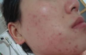 青春痘症状有哪些