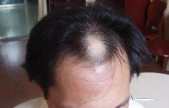 斑秃是怎么造成的