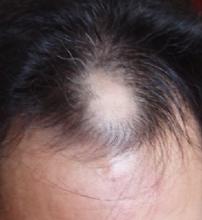头顶脱发该怎么护理