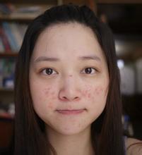 青春痘患者需要注意的地方