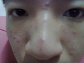青春痘要及时治疗