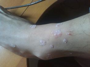 牛皮癣患者要远离潮湿环境