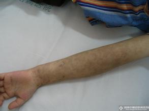 紫癜患者吃什么好