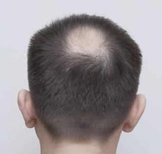 脱发的发生都与那些因素有关