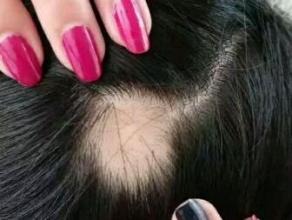 女性面临掉头发，如何轻松解决