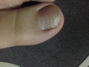 灰指甲明显的症状